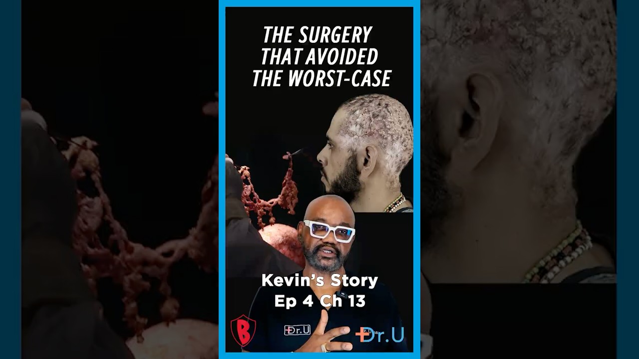 Ep 4 Ch 13: How Kevin Avoided Total Scalp Excision | Dissecting Cellulitis Treatment