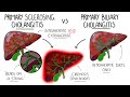 Primary Sclerosing Cholangitis v Primary Biliary Cholangitis (Primary Biliary Cirrhosis)