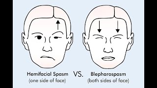 হেমিফেসিয়াল-স্পাজম Hemifacial_Spasm MVD Functional-Neurosurgery Dr._Jalal_Uddin_Mohammad_Rumi