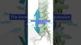 Download Lagu Is het effect van spinale decompressie tijdelijk? MP3