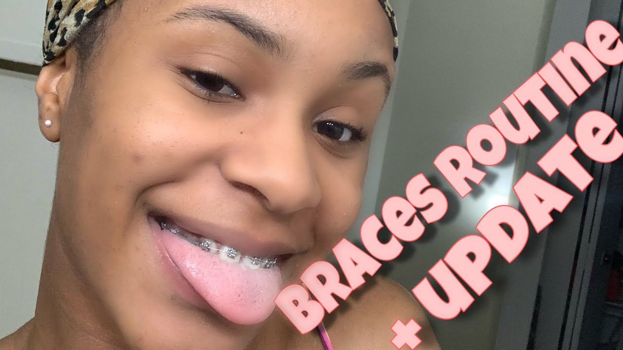 How I keep my teeth white with braces + update - YouTube