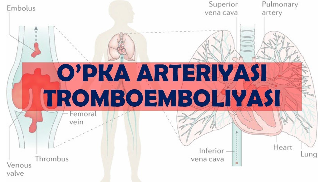 𝙾'𝙿𝙺𝙰 𝙰𝚁𝚃𝙴𝚁𝙸𝚈𝙰𝚂𝙸 𝚃𝚁𝙾𝙼𝙱𝙾𝙴𝙼𝙱𝙾𝙻𝙸𝚈𝙰𝚂𝙸 [𝙴𝙼𝙱𝙾𝙻𝙸𝚈𝙰]