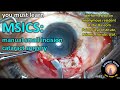 Msics manual small incision cataract surgery