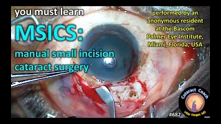 MSICS: manual small incision cataract surgery