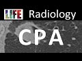 Radiology of chronic pulmonary aspergillosis