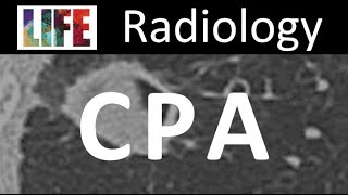 Radiology of chronic pulmonary aspergillosis