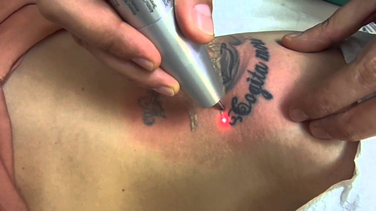 Laser Tattoo Removal in New York City | Any Color Ink | StudioMD NYC