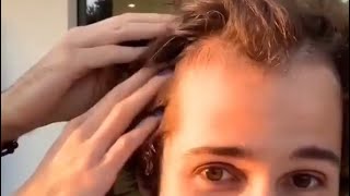 Why David Dobrik is balding