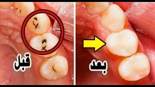 كيفية تبييض الاسنان بالمنزل خلال 5 دقائق وصفة مجربة 100%
