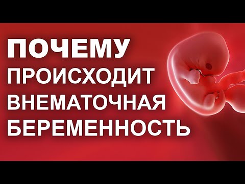 Причины и последствия внематочной беременности. Внематочная беременность.