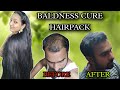 100     baldness cure home remedy