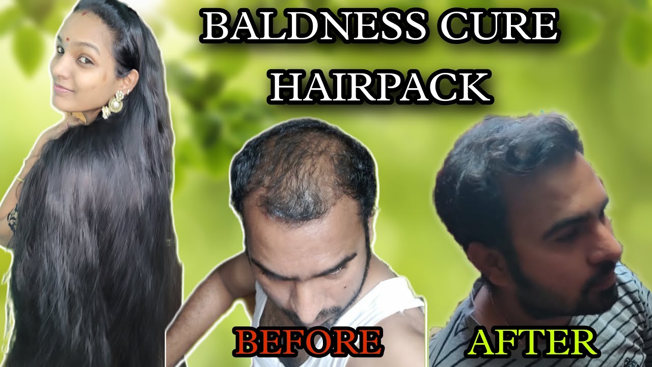 100     BALDNESS CURE HOME REMEDY