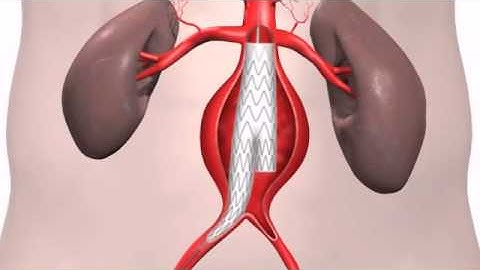 Endovascular surgery for Abdominal Aortic Aneurysm