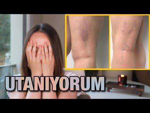 2 KEZ VARİS TEDAVİSİ OLDUM SONUÇ?? | Konuşulmayanları Açıklıyorum!