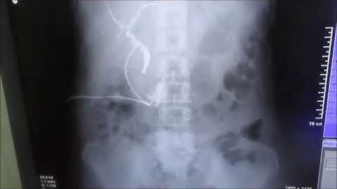 T-Tube Cholangiogram