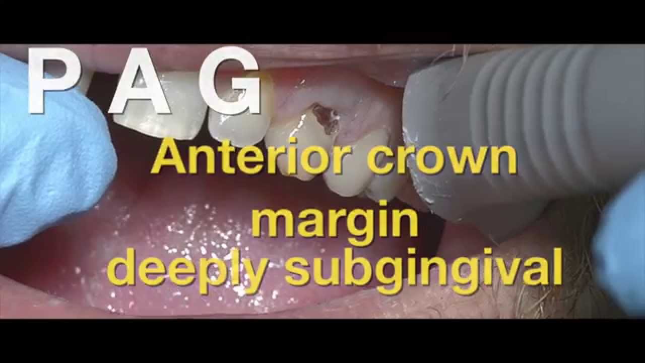Esthetic anterior ceramic crown, deep subgingival margin cadcam YouTube