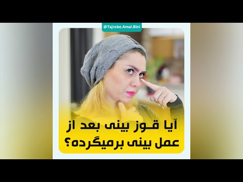 قوز بینی بعد از جراحی