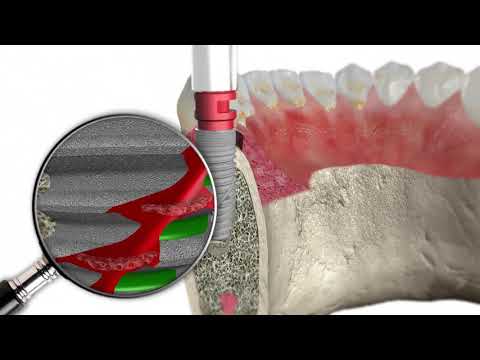 Video: Hjerneimplantat Fra DARPA - Alternativt Syn