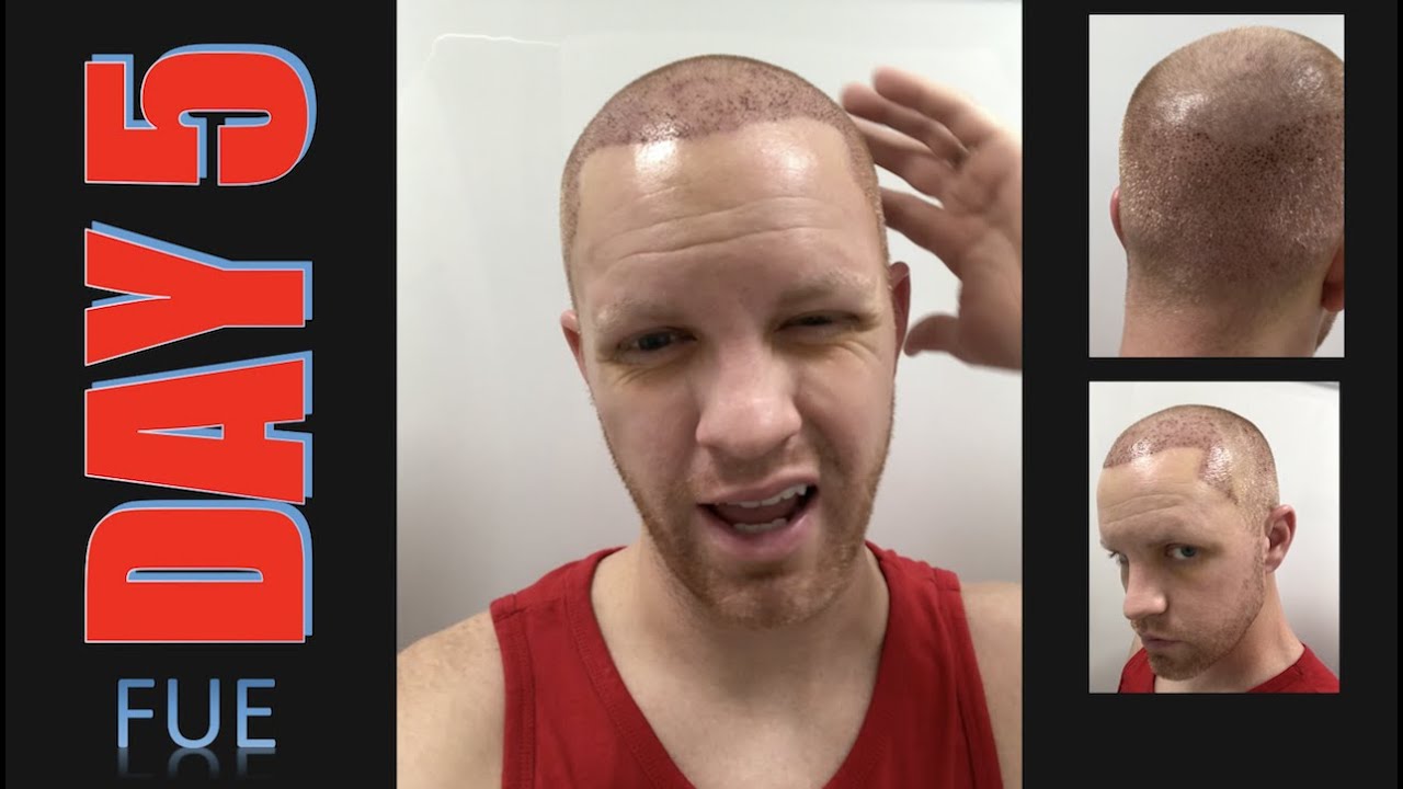 DAY 5 After FUE Hair Transplant - YouTube