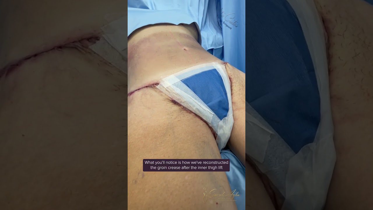 Back Lipo, Upper Body Lift Redo, Outer, Inner, Anterior Thigh Lift