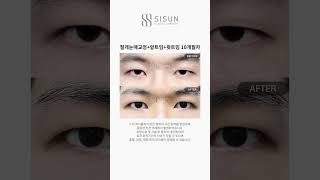 [B&amp;A] 절개눈매교정+앞트임+윗트임 10개월차