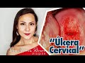 "Úlcera Cervical"