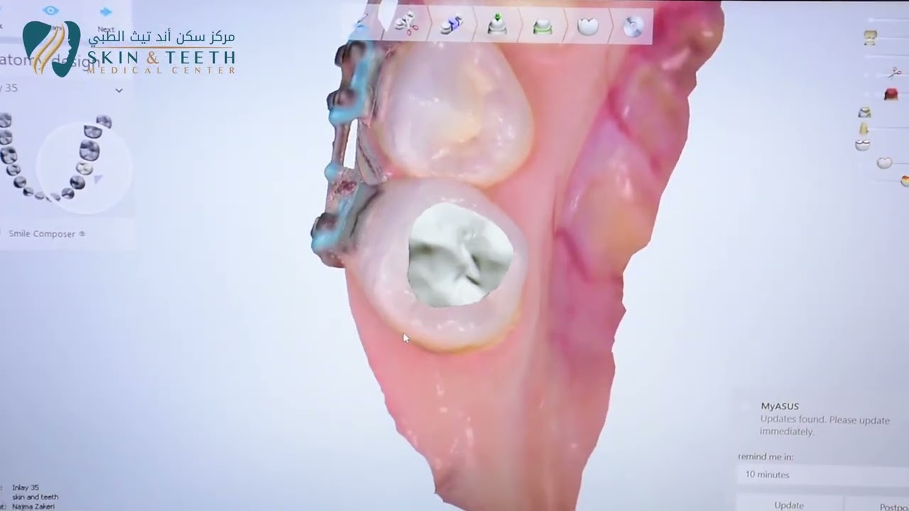 Skin & Teeth Medical Center Ceramic Filling YouTube