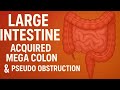Large Intestine Acquired Megacolon &amp; Pseudo-Obstruction | Causes, Diagnosis &amp; Management