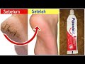 CARA MENGHILANGKAN KAKI PECAH PECAH!! TUMIT LANGSUNG MULUS!!