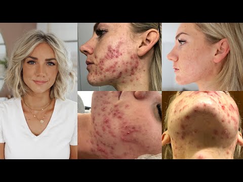 Video: Eliminate Acne Naturally With These Products