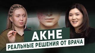 видео: ВСЯ ПРАВДА ОБ АКНЕ: РАЗВЕНЧИВАЕМ МИФЫ И РАСКРЫВАЕМ СЕКРЕТЫ ЛЕЧЕНИЯ картинка: ВСЯ ПРАВДА ОБ АКНЕ: РАЗВЕНЧИВАЕМ МИФЫ И РАСКРЫВАЕМ СЕКРЕТЫ ЛЕЧЕНИЯ
