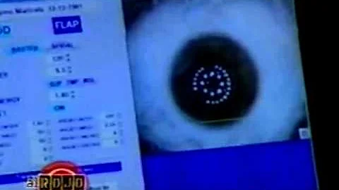 Laser Eye Surgery by Dr. Cory Lessner on UNIVISION