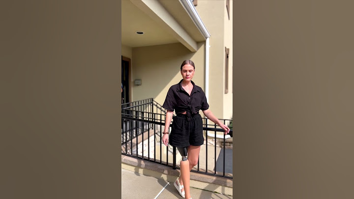 Francesca Receives a Hyper-Realistic Silicone Above-Knee Prosthesis