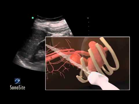 How To: Left Kidney Ultrasound 3D Video