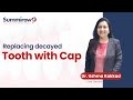 Dental decay  dental cap case study  dr ushma kakkad  summirow dental