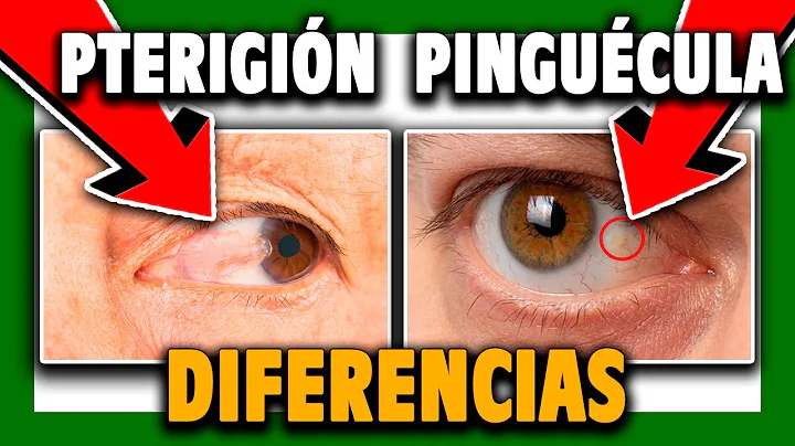 PTERIGION y PINGUECULA: Diferencias, tratamientos,...