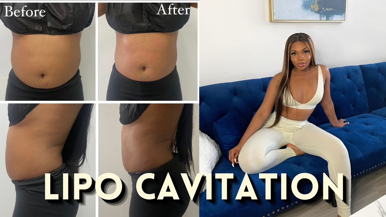 LIPO CAVITATION REVIEW  DOES IT REALLY WORK? *BEFORE AND AFTER* 