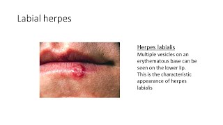 Genital Herpes/Labial Herpes by House Job 8 views 1 month ago 5 minutes, 15 seconds