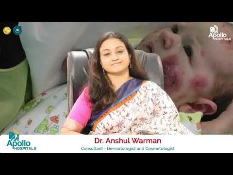 What is Sweet Syndrome? | Is it Contagious? | Apollo Hospitals