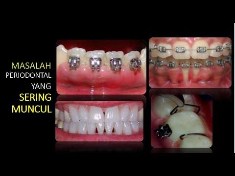 Video: Perbaikan Kerusakan Tulang Periodontal Manusia Dengan Sel Batang Okulasi Autologous Yang Berasal Dari Jaringan Pulpa Gigi Radang