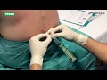 Epimatic: cómo detectar el espacio epidural con una jeringa de baja resistencia
