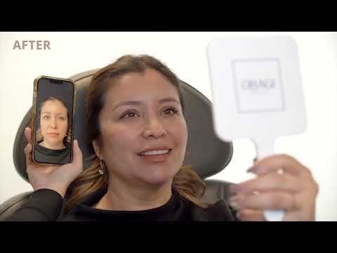 How JUVÉDERM® VOLUX®