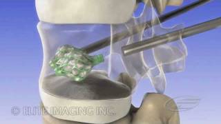 Vertebral Augmentation - Medical & Scientific Video Production