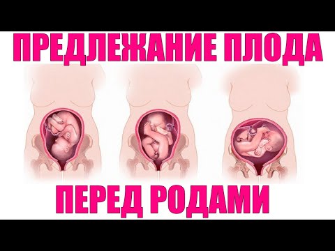 ПОЛОЖЕНИЕ РЕБЕНКА ВО ВРЕМЯ БЕРЕМЕННОСТИ | Когда ребенок переворачивается вниз головой в животе мамы