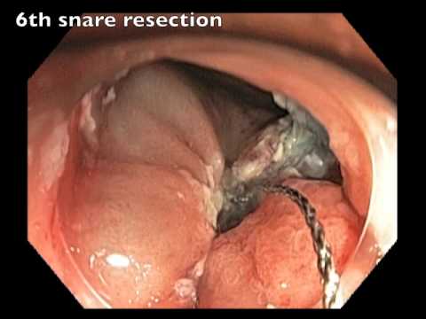 Colonoscopy:Rectum - LST-G Tumor - Piecemeal EMR