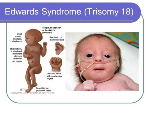 Video: Apa itu sindrom trisomi 8?