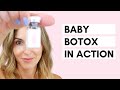 Baby Botox Facial: How to Use a Hydro Needle for Microneedling with Botulax 200