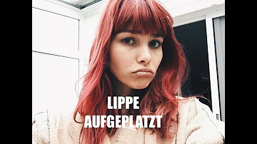 Was macht man bei aufgeplatzter Lippe?