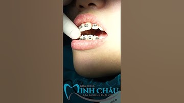 Niềng Răng Tại Nha Khoa Minh Châu | Nha Khoa Minh Châu