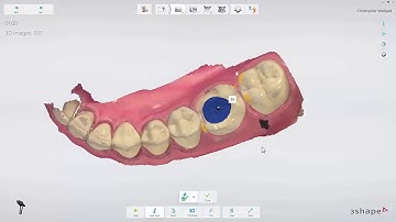 3Shape TRIOS - Escaneamento de vários núcleos intra-radiculares